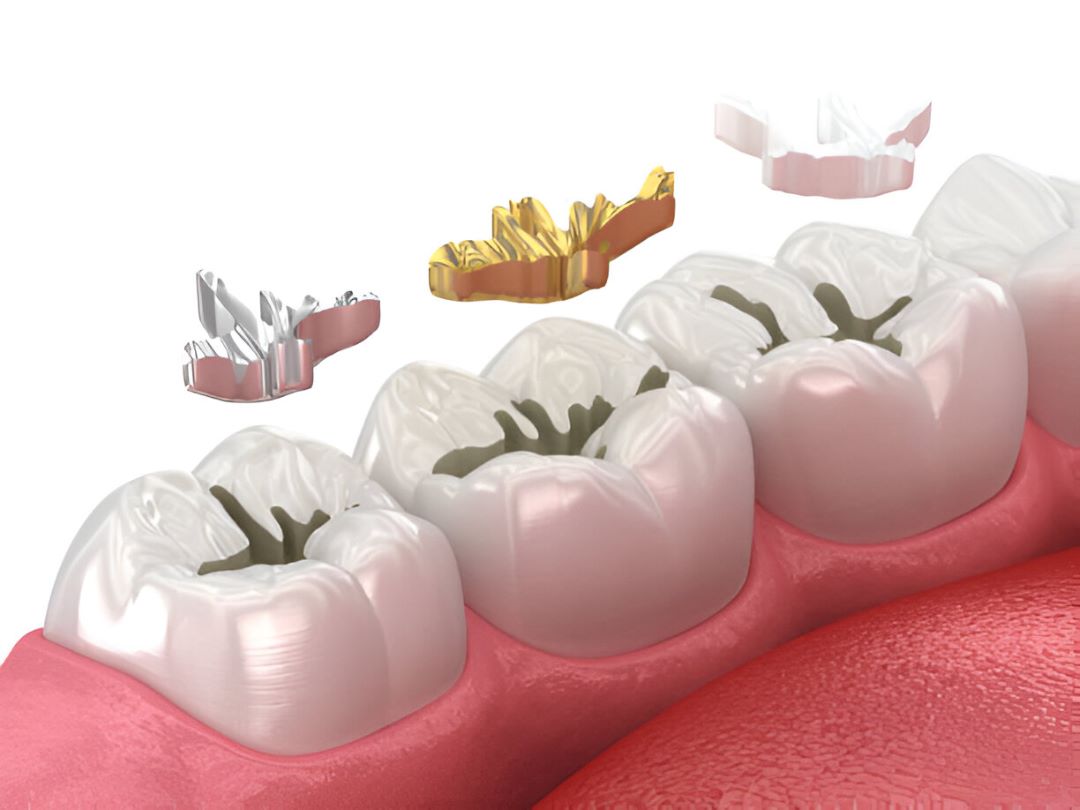 Different types of dental fillings including amalgam, gold, ceramic, and composite materials