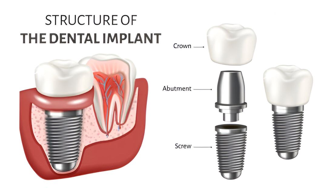 Structure of dental implant showing crown, abutment, and screw components