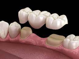 Dental bridge showing how crowns support artificial teeth to replace missing teeth