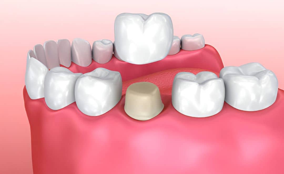 Dental crown procedure showing how a crown fits over a prepared tooth