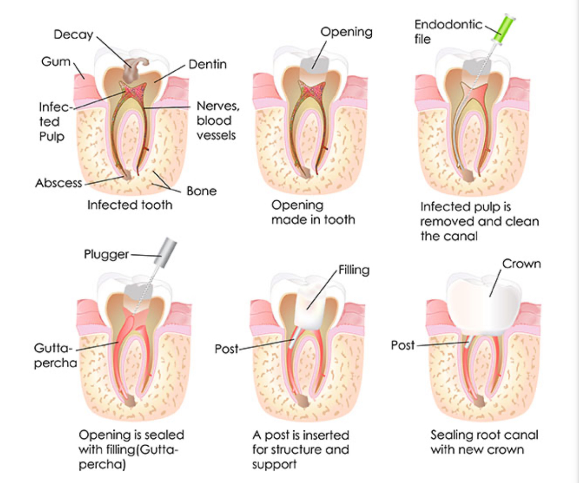 Root Canal Treatment Procedure - Step by step visual guide showing the process from infected tooth to final restoration with crown